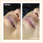 radiance_hidralips_antes_despues_1