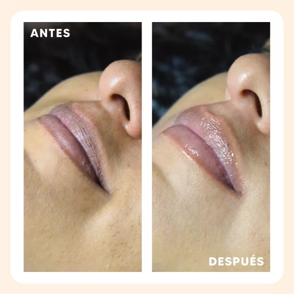 radiance_hidralips_antes_despues_1