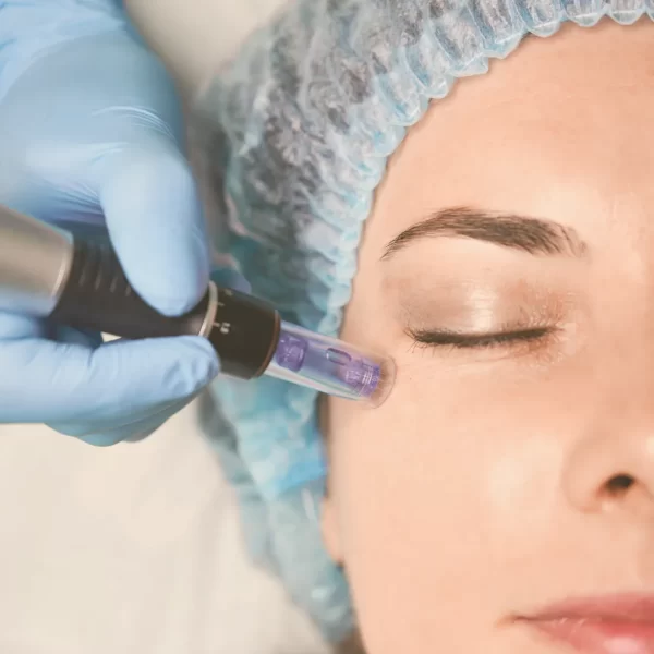 radiance_trata,miento_regenerador_dermapen_facial